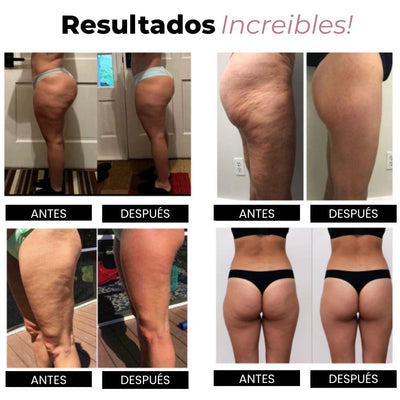 Resultados increíbles con calzas anticelulitis Drenalia: cuatro pares de fotos de antes y después en muslos y glúteos