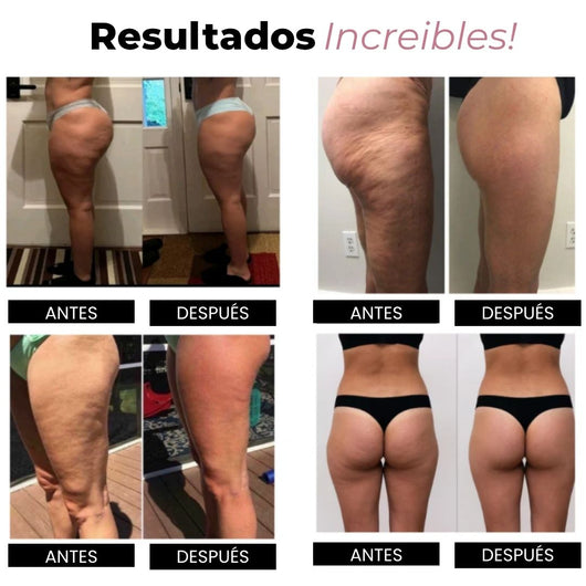 Resultados increíbles con calzas anticelulitis Drenalia: cuatro pares de fotos de antes y después en muslos y glúteos